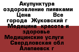 Акупунктура, оздоровление пиявками › Цена ­ 3 000 - Все города, Жуковский г. Медицина, красота и здоровье » Медицинские услуги   . Свердловская обл.,Алапаевск г.